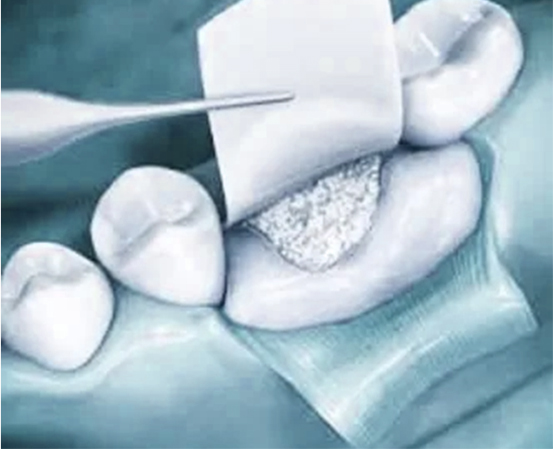 BONE REGENERATION
