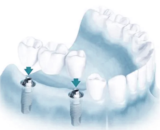 IMPLANT BRIDGE