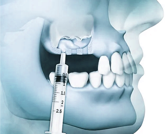 SINUS LIFT